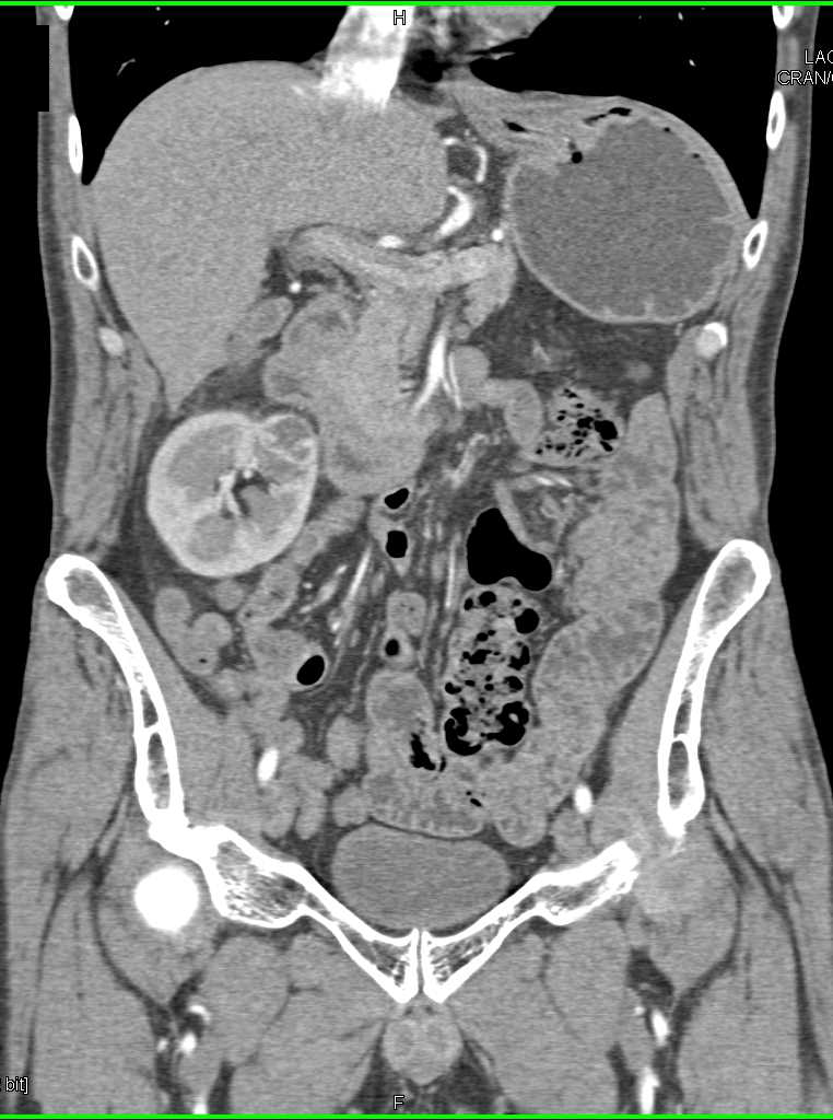 2 cm Right Renal Cell Carcinoma - CTisus CT Scan