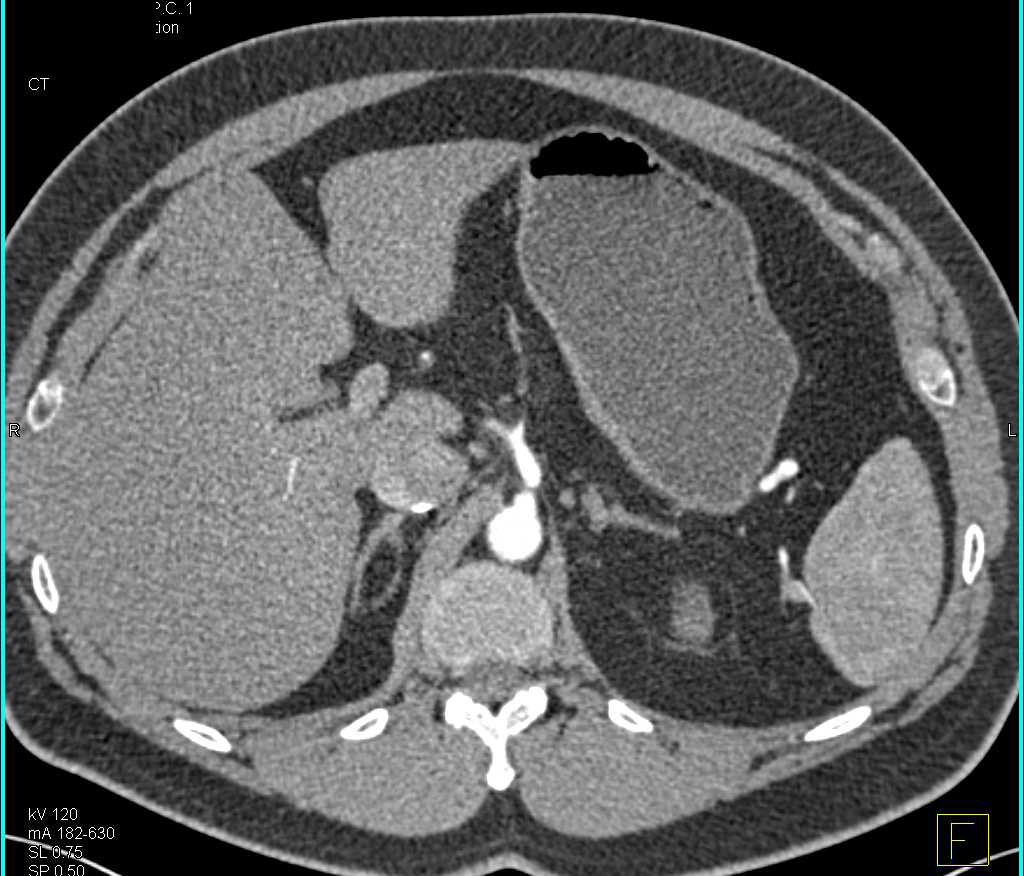 Transitional Cell Carcinoma Right Renal Pelvis and Liver Metastases - CTisus CT Scan