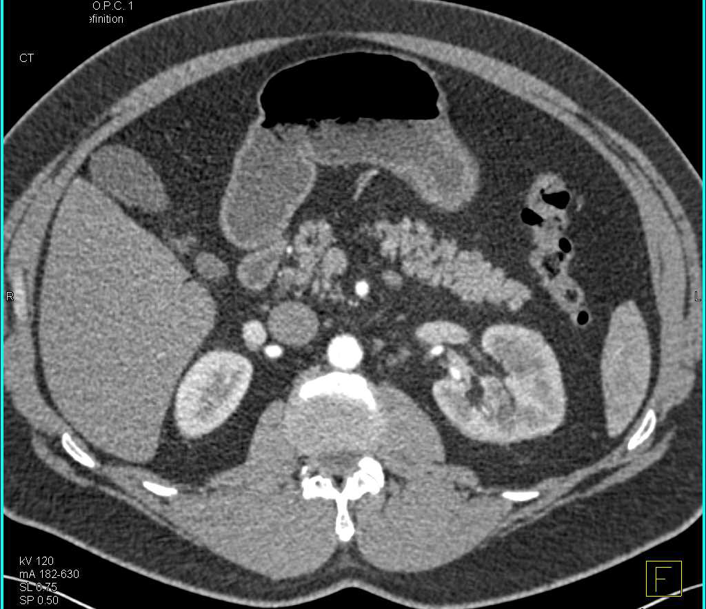 Transitional Cell Carcinoma Left Renal Pelvis - CTisus CT Scan