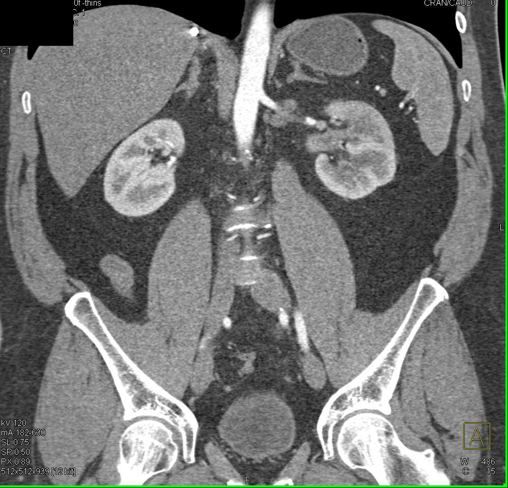 Transitional Cell Carcinoma Left Renal Pelvis - CTisus CT Scan