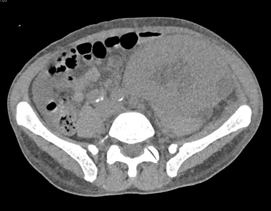 Enlarged Transplant Kidney with Acute Pyelonephritis - CTisus CT Scan