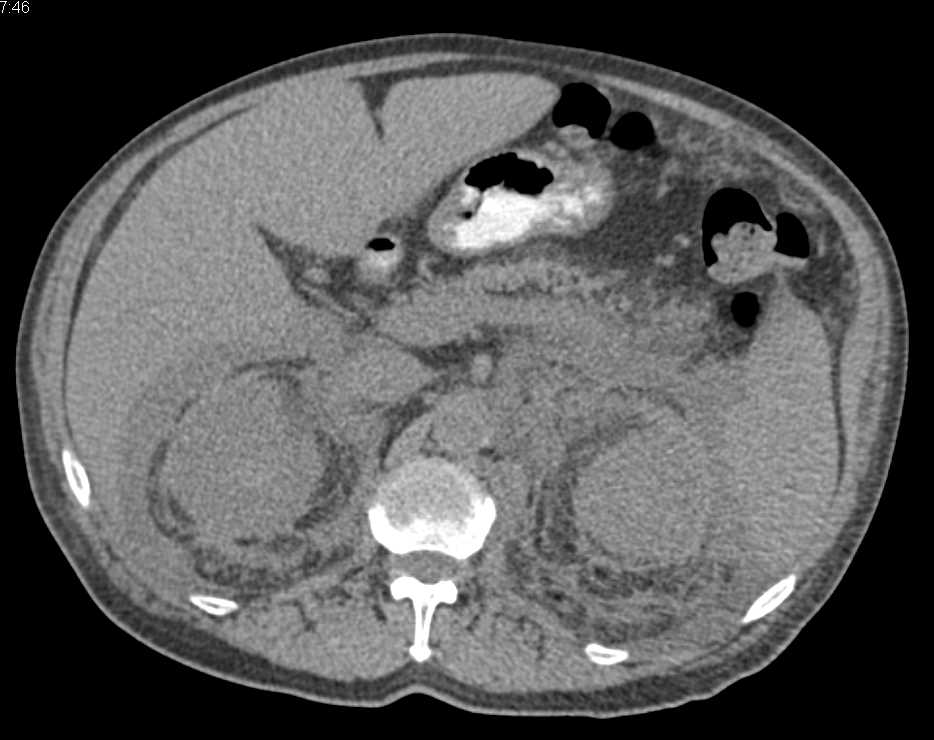 Retroperitoneal Fibrosis - CTisus CT Scan