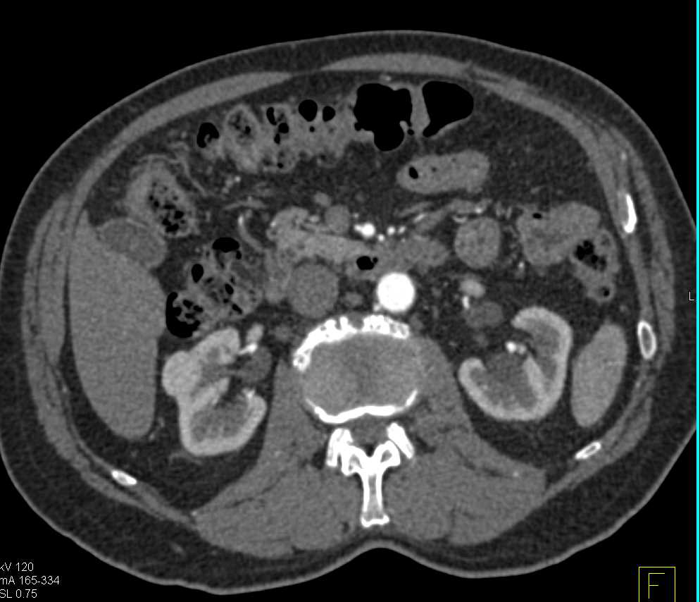 von Hippel Lindau with Right Renal Cell Carcinoma, and Hemangioblastomas to the Spinal Cord - CTisus CT Scan