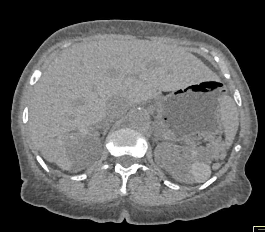 Multiple High Density Renal Cysts - CTisus CT Scan