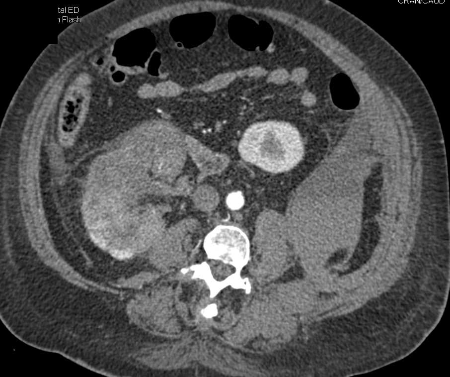 Infiltrating Renal Cell Carcinoma Right Kidney and Large Bleed Near Left Kidney - CTisus CT Scan