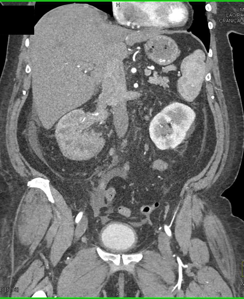 Renal Cell Carcinoma Involves the Renal Vein and Inferior Vena Cava (IVC) - CTisus CT Scan