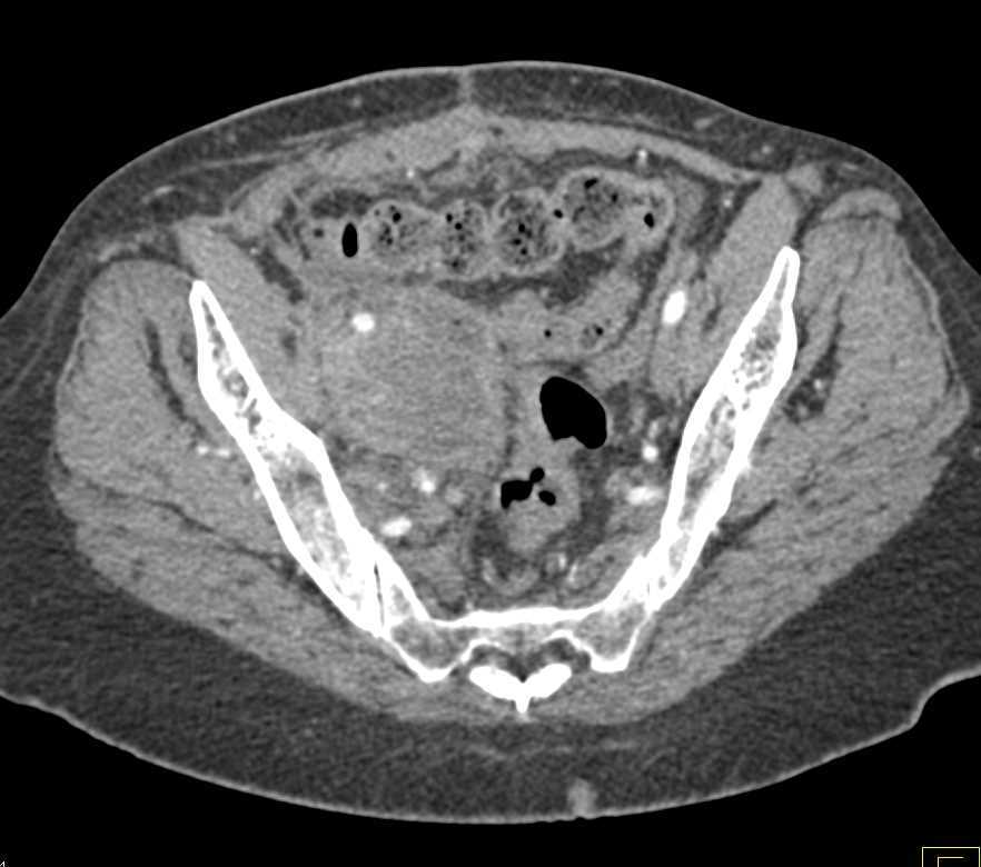 Large Necrotic Nodal Mass Obstructs Ureter - CTisus CT Scan