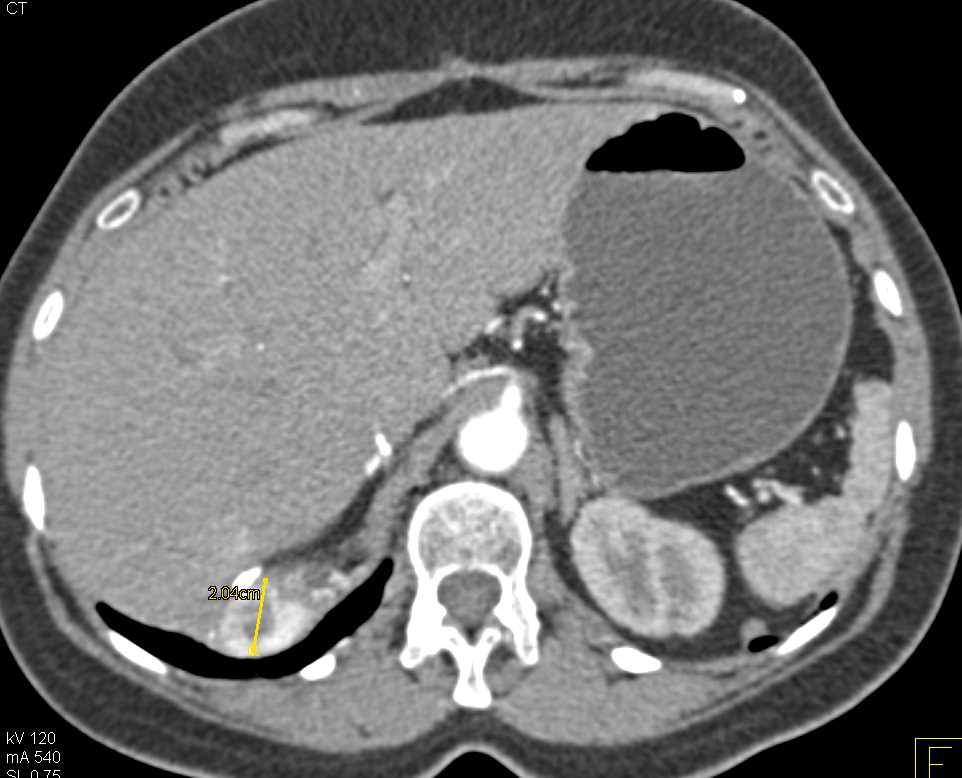 Right Nephrectomy with Recurrent Renal Cell Carcinoma - CTisus CT Scan