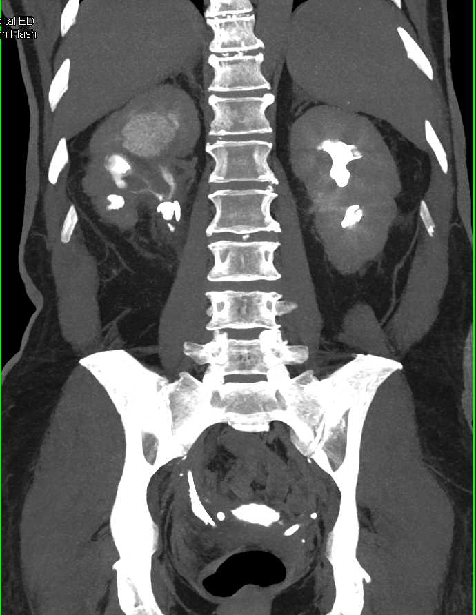 Transitional Cell Carcinoma of the Right Renal Pelvis and Proximal Ureter - CTisus CT Scan