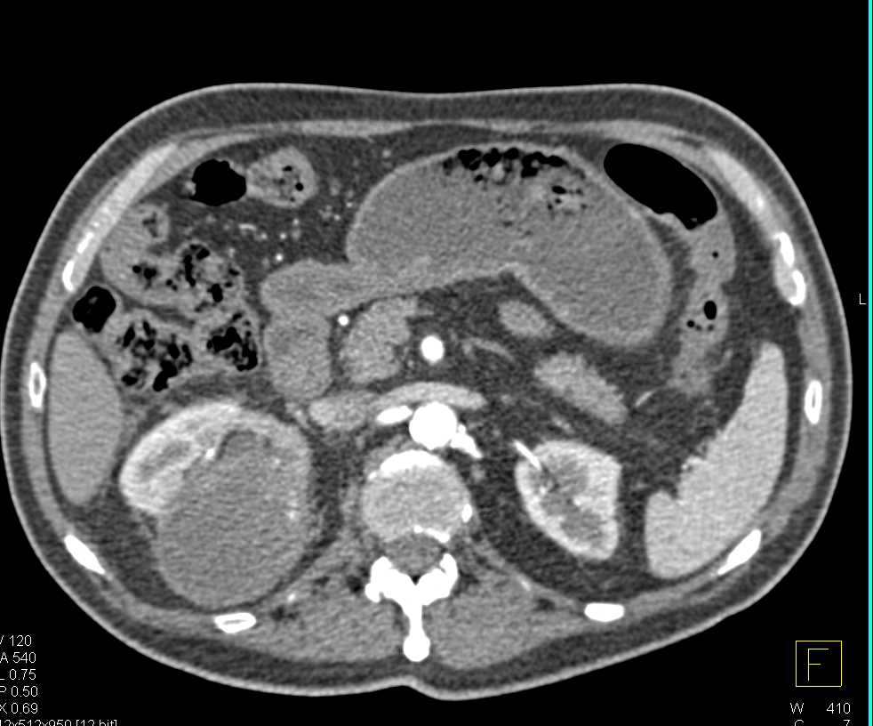 Cystic Right Renal Cell Carcinoma - CTisus CT Scan