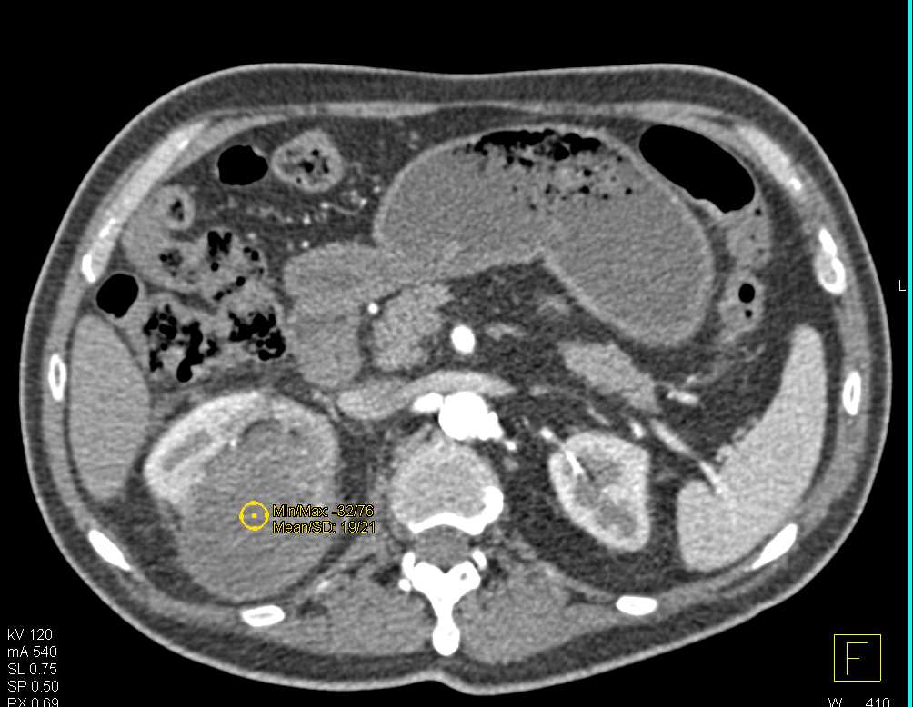 Cystic Right Renal Cell Carcinoma - CTisus CT Scan