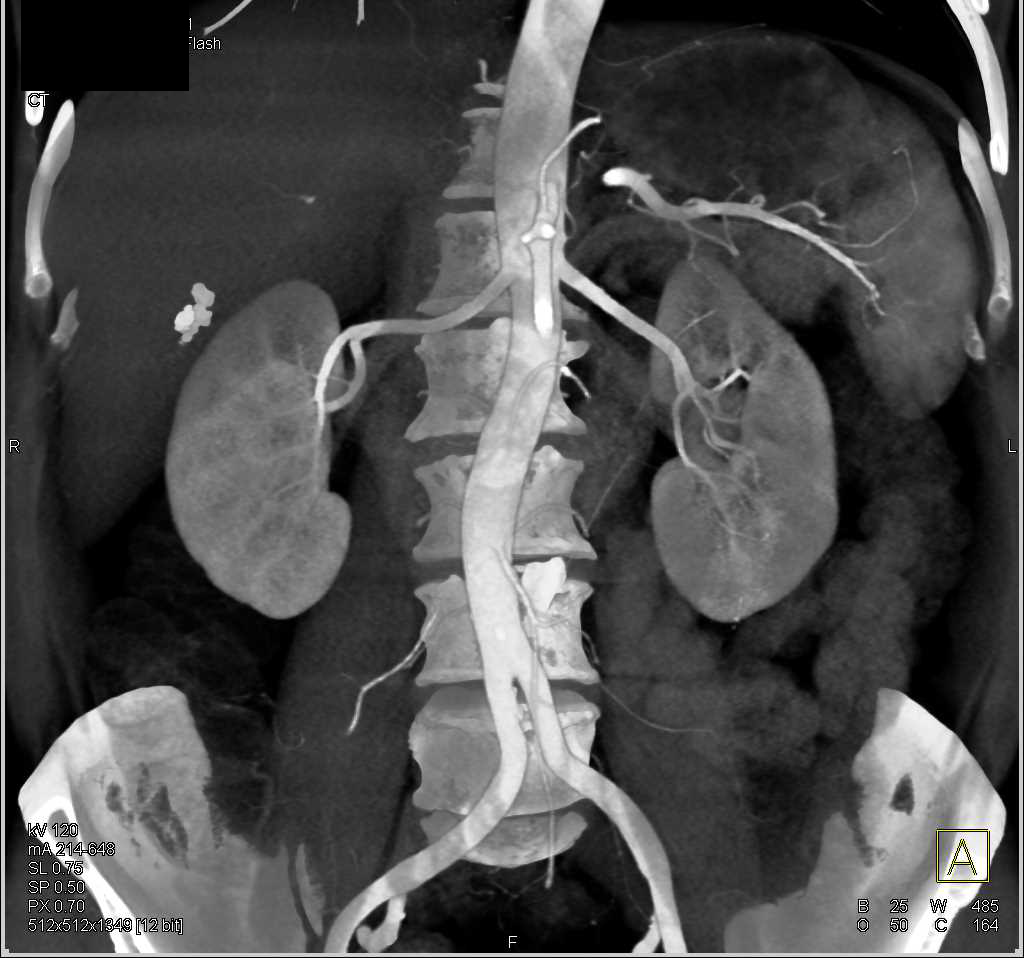 Normal Renal Arteries - Kidney Case Studies - CTisus CT Scanning