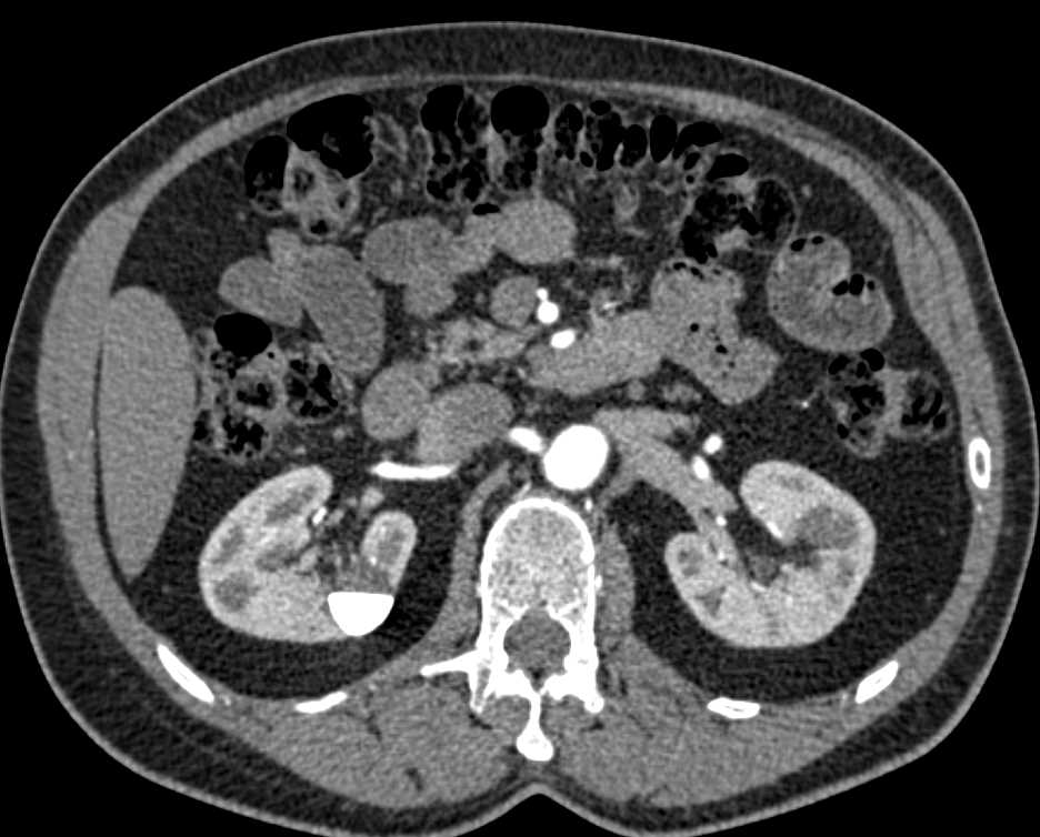 Calyceal Diverticulum Right Kidney - CTisus CT Scan
