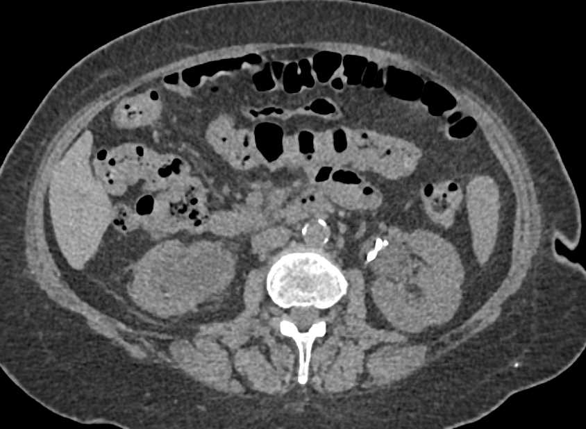 Transitional Cell Carcinoma of the Right Ureter and Bladder - CTisus CT Scan