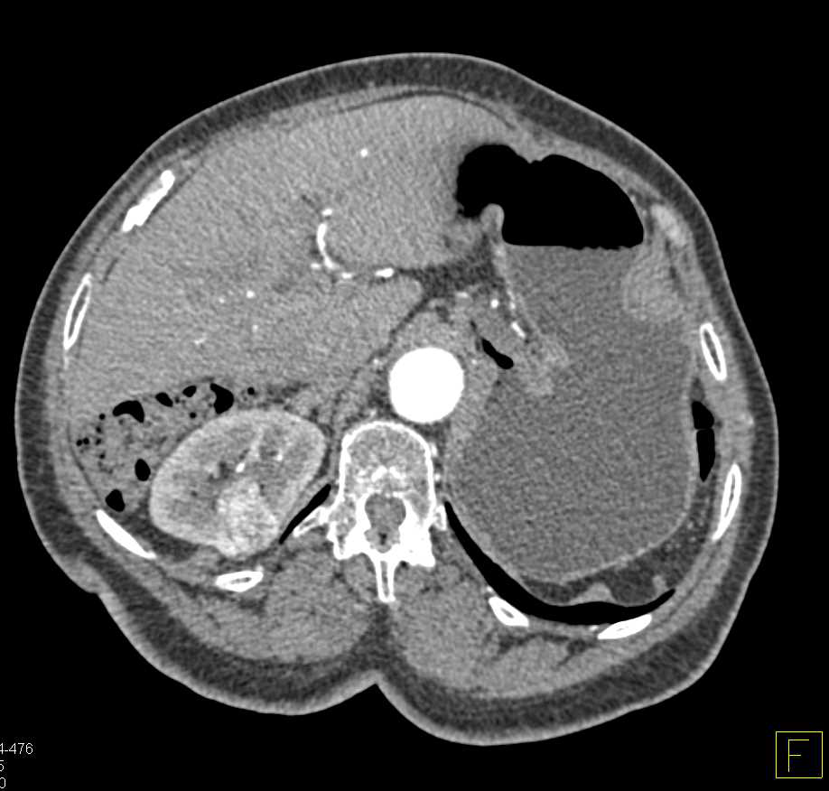 Metastatic Renal Cell Carcinoma to the Contralateral Kidney - CTisus CT Scan