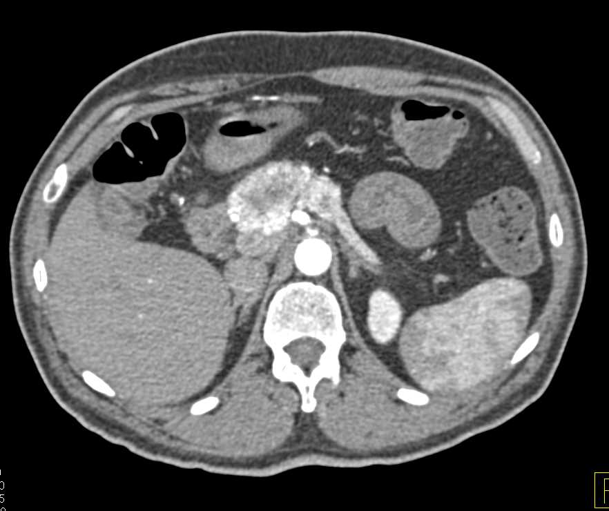 Metastatic Renal Cell Carcinoma Recurrence to the Pancreas - CTisus CT Scan