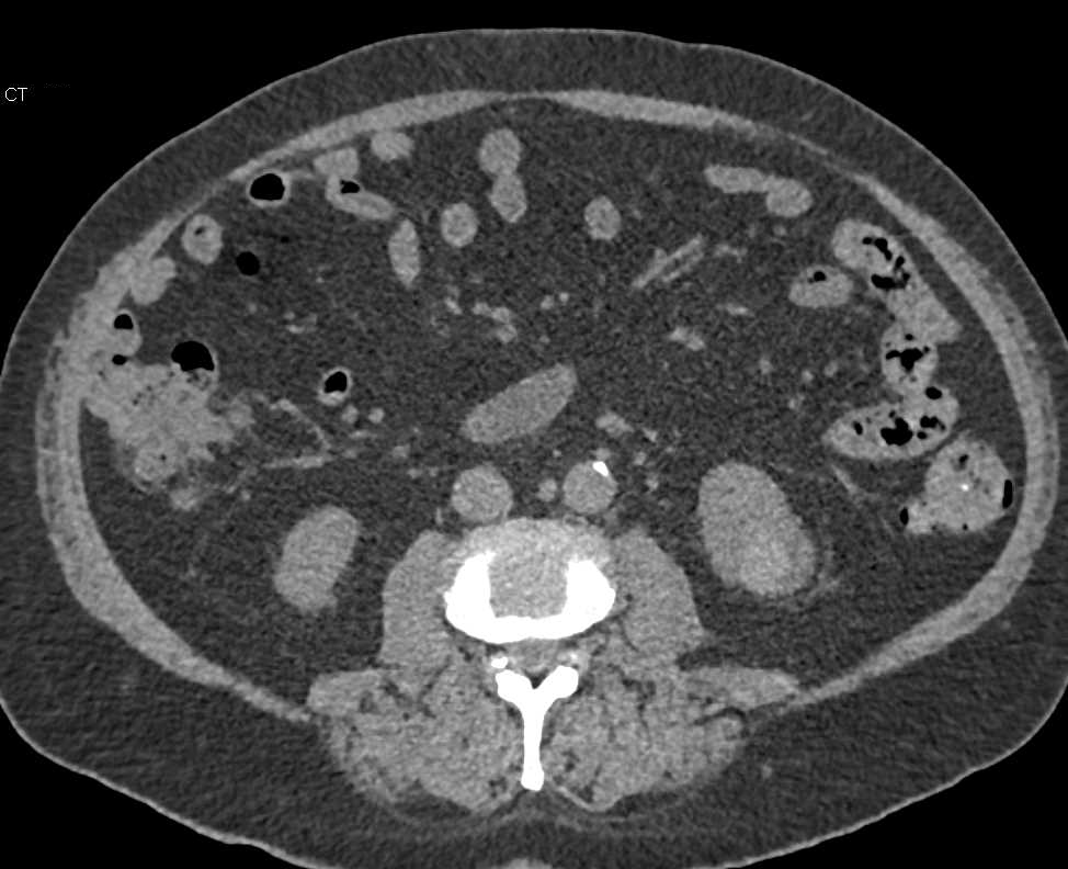 Bladder Cancer and Incidental Left Papillary Renal Cell Carcinoma - CTisus CT Scan