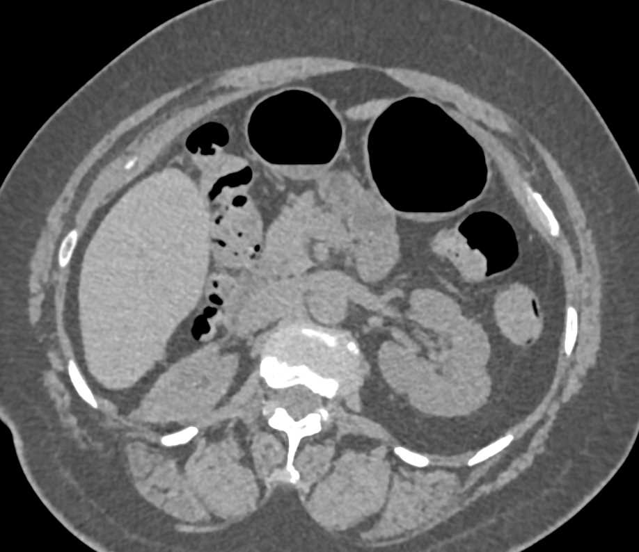 Subtle Transitional Cell Carcinoma Right Ureter - CTisus CT Scan