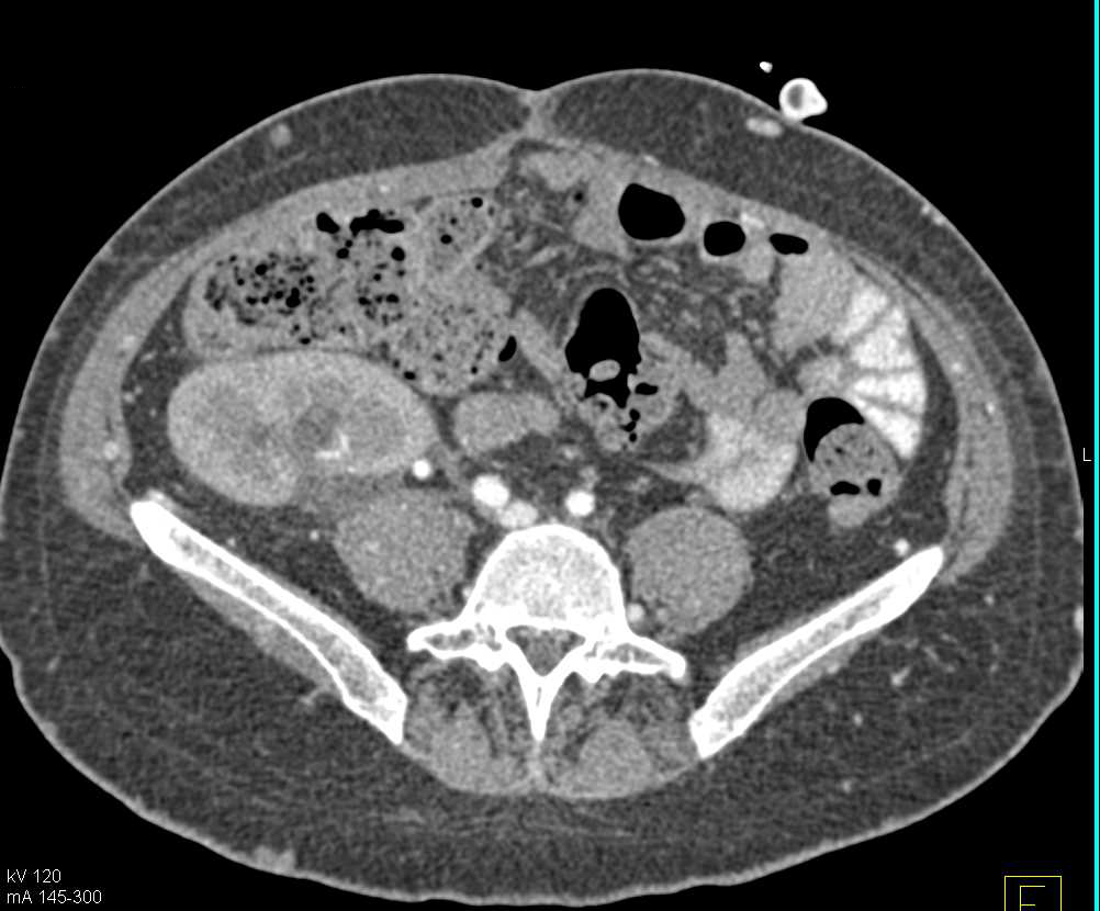 Aneurysm Upper Pole Renal Artery in Transplant Kidney - CTisus CT Scan