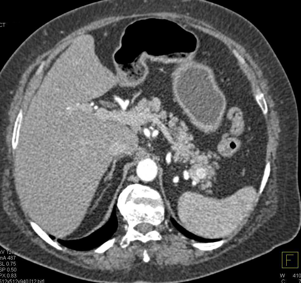 Metastatic Renal Cell Carcinoma to the Pancreatic Tail and Contralateral Kidney - CTisus CT Scan