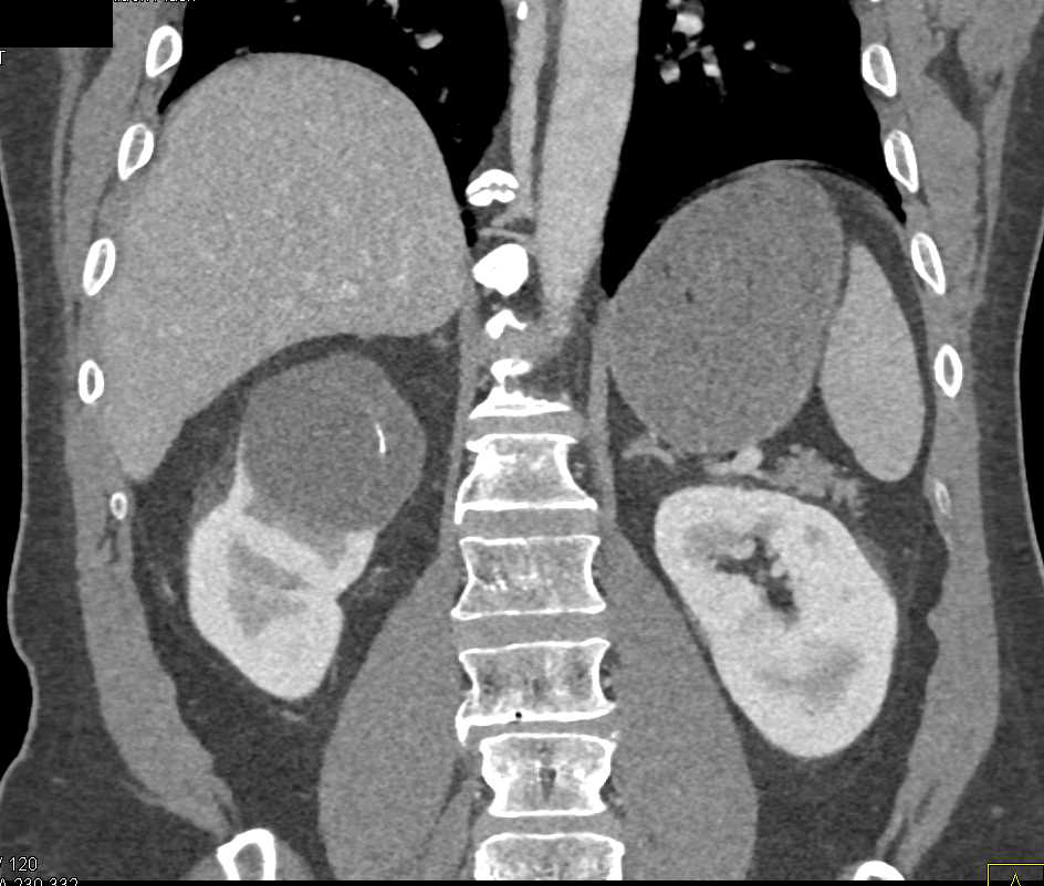 Bosniak 2F Cyst Right Kidney - CTisus CT Scan