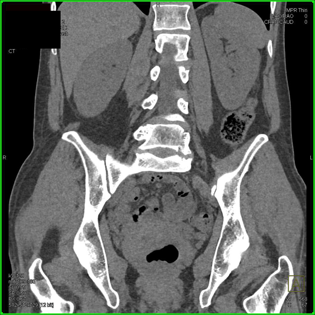 Transitional Cell Carcinoma of the Proximal Left Ureter - CTisus CT Scan