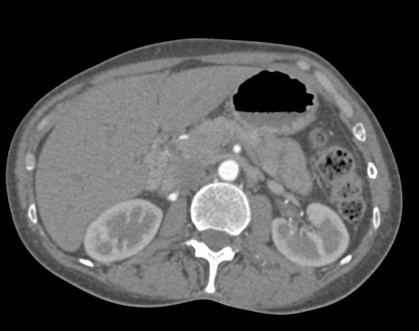 Fibromuscular Dysplasia (FMD) of the Renal Arteries - CTisus CT Scan