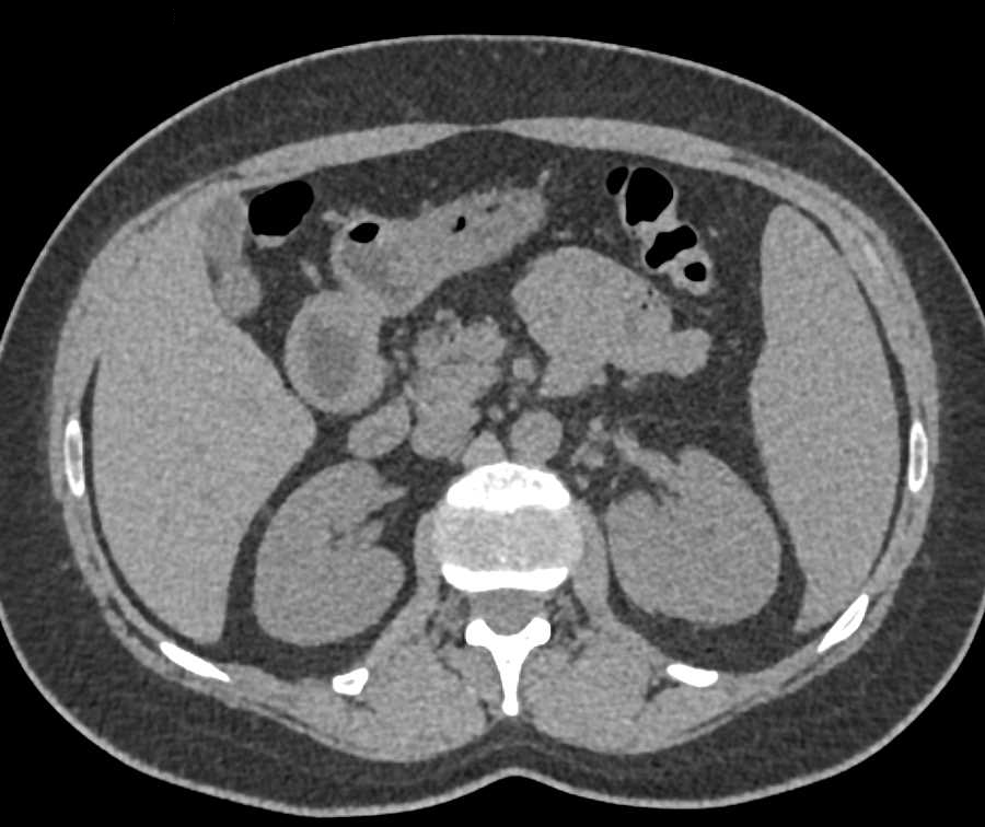 Perirenal Lymphoma Left Kidney - CTisus CT Scan