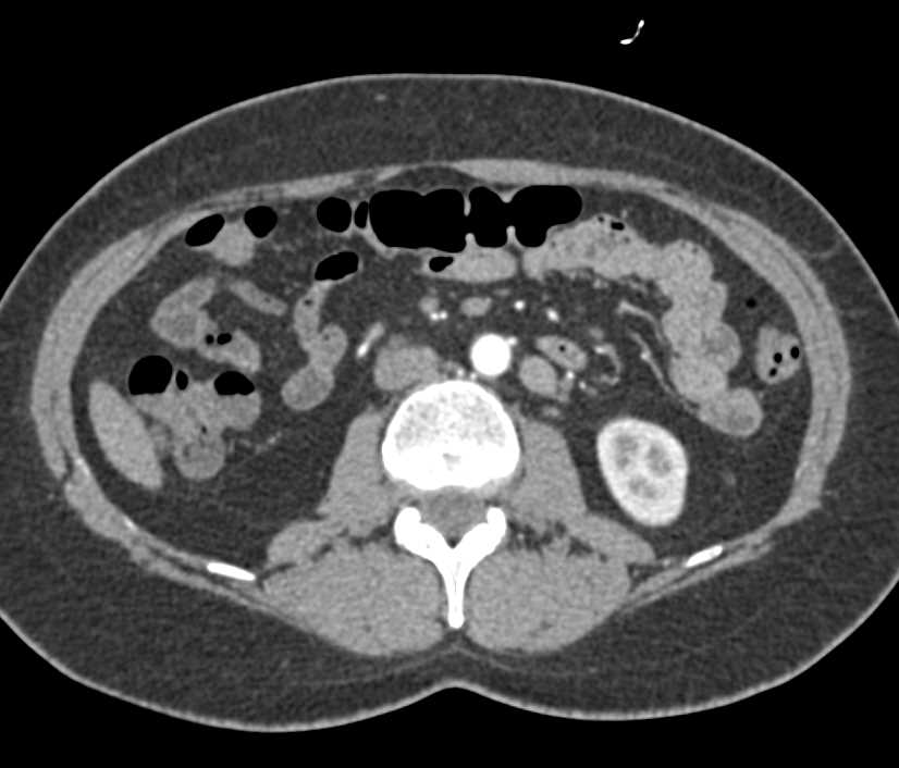 Perirenal Lymphoma Left Kidney - CTisus CT Scan