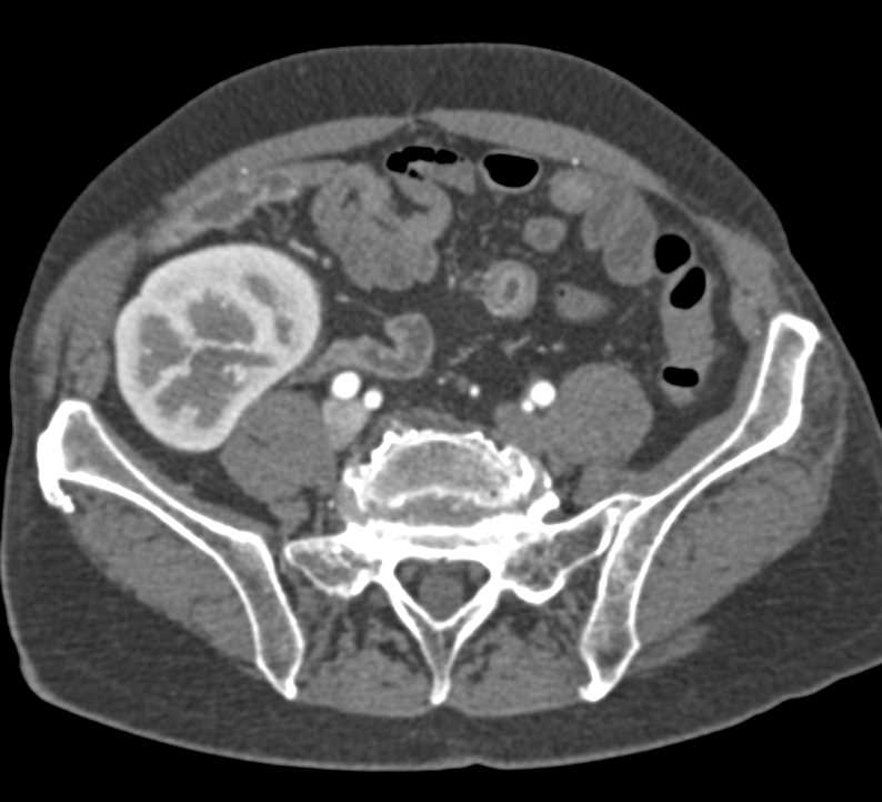 Normal Renal Transplant Study - CTisus CT Scan