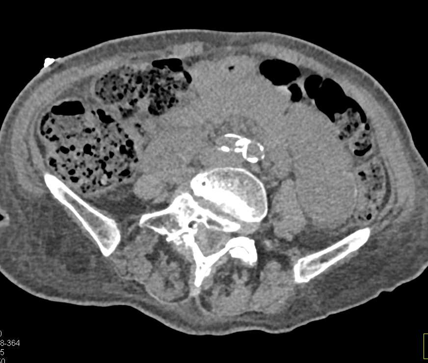 Papillary Renal Cell Carcinoma - CTisus CT Scan