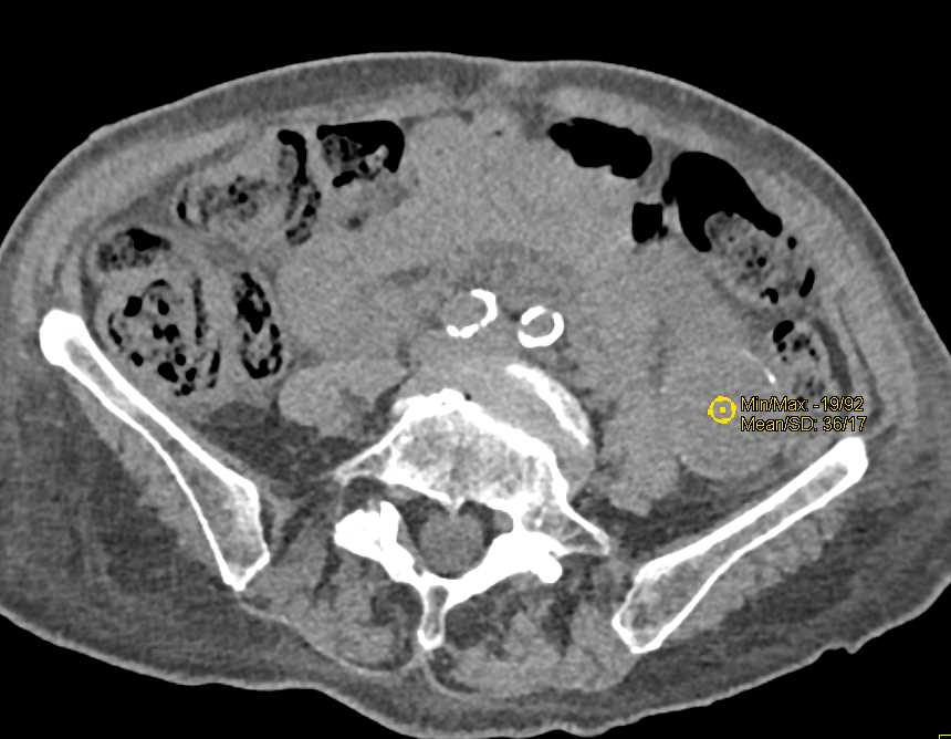 Papillary Renal Cell Carcinoma - CTisus CT Scan