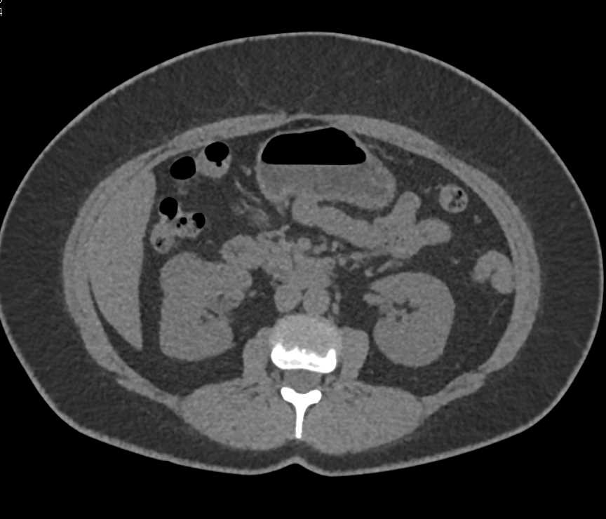 Papillary Left Renal cell Carcinoma - CTisus CT Scan