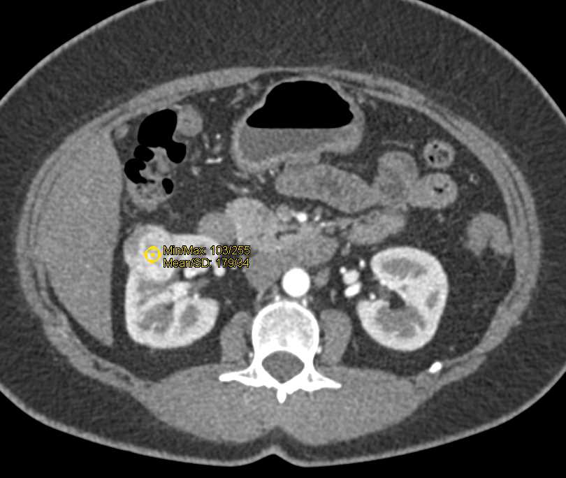 Papillary Renal Cell Carcinoma - CTisus CT Scan