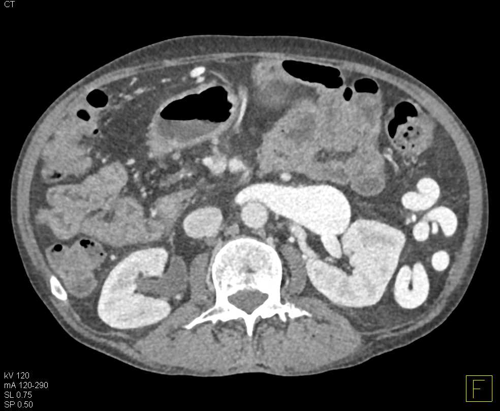 Splenorenal Shunting with Dilated Left Renal Vein - CTisus CT Scan