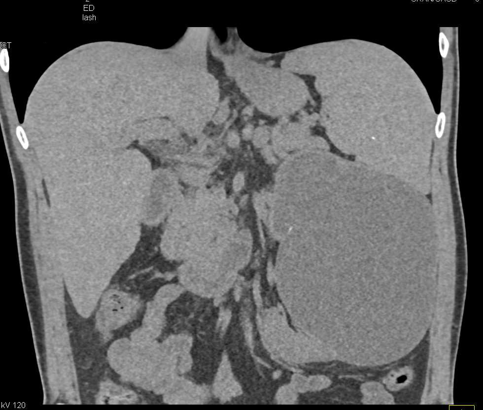 Obstructed Upper Pole of Left Duplicated Kidney Collecting System - CTisus CT Scan