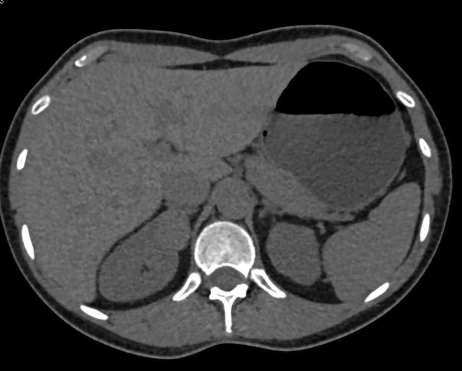 Well Defined Right Papillary Renal Cell Carcinoma - CTisus CT Scan