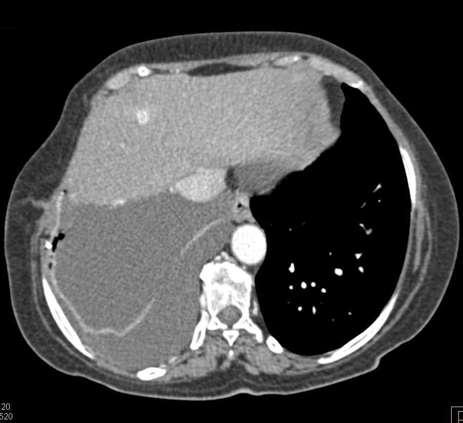 Vascular Metastases to Liver and Bone from Recurrent Renal Cell Carcinoma - CTisus CT Scan