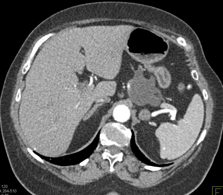 Transitional Cell Carcinoma Left Ureter - CTisus CT Scan