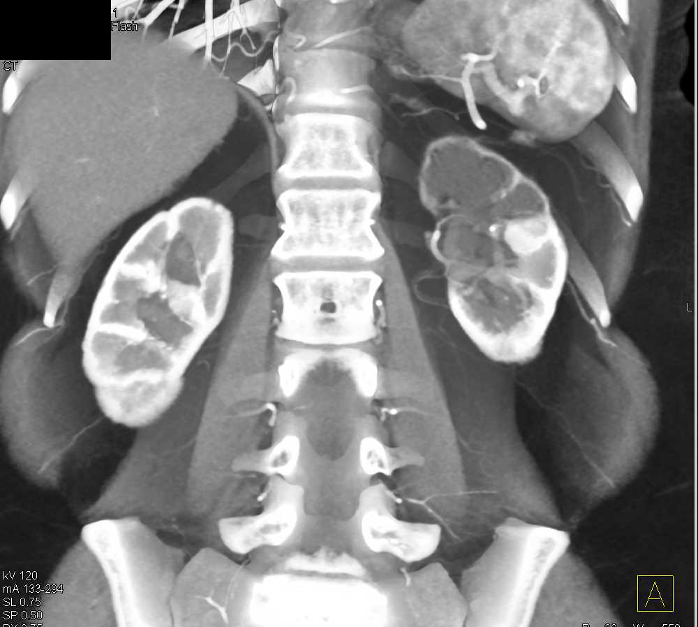 Dilated Calyces Upper Pole Left Kidney with Loss of Cortex - CTisus CT Scan