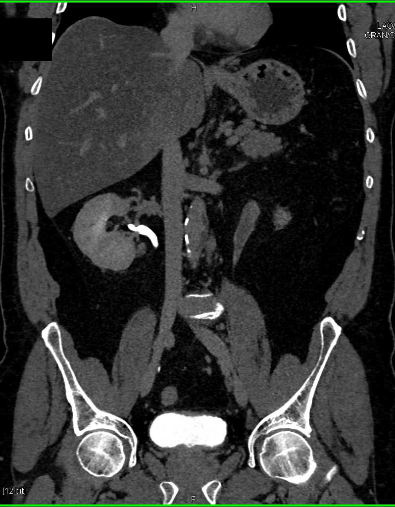 Transitional Cell Carcinoma Left Ureter - CTisus CT Scan