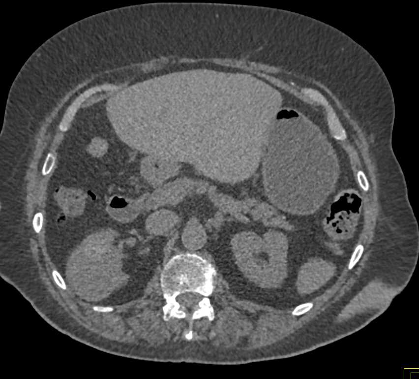 Cystic Renal Cell Carcinoma - CTisus CT Scan