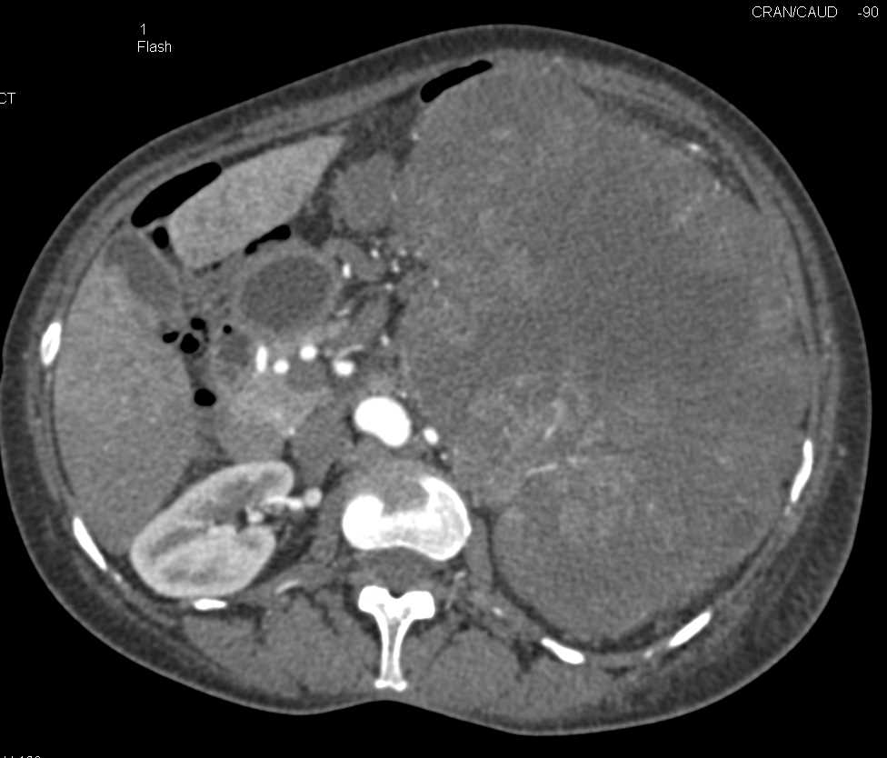 Large Necrotic Left Renal Cell Carcinoma - CTisus CT Scan