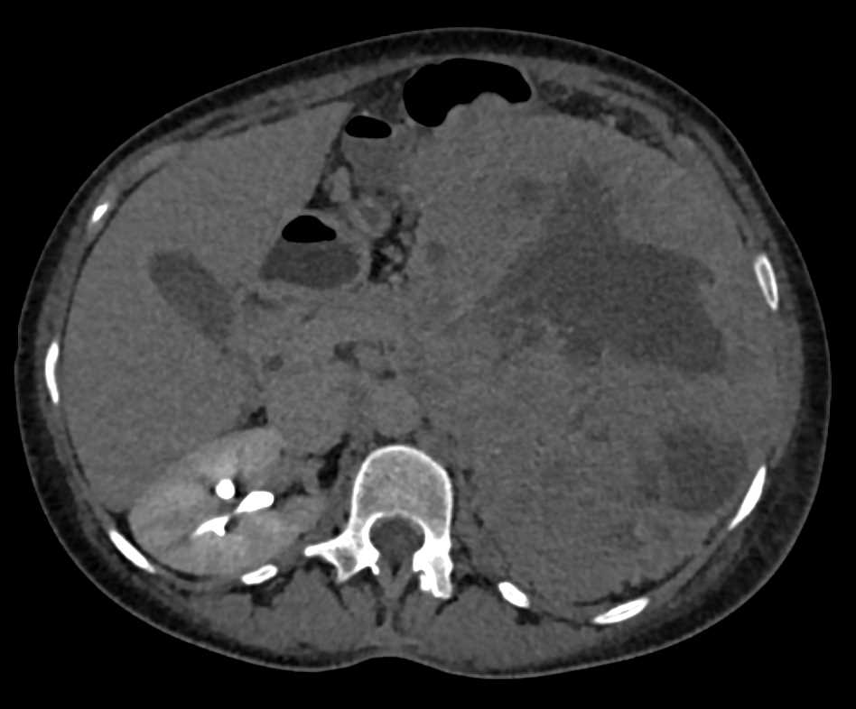 Large Necrotic Left Renal Cell Carcinoma - CTisus CT Scan