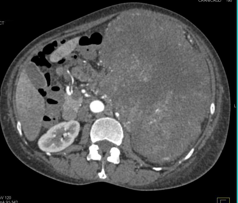 Large Necrotic Left Renal Cell Carcinoma - CTisus CT Scan