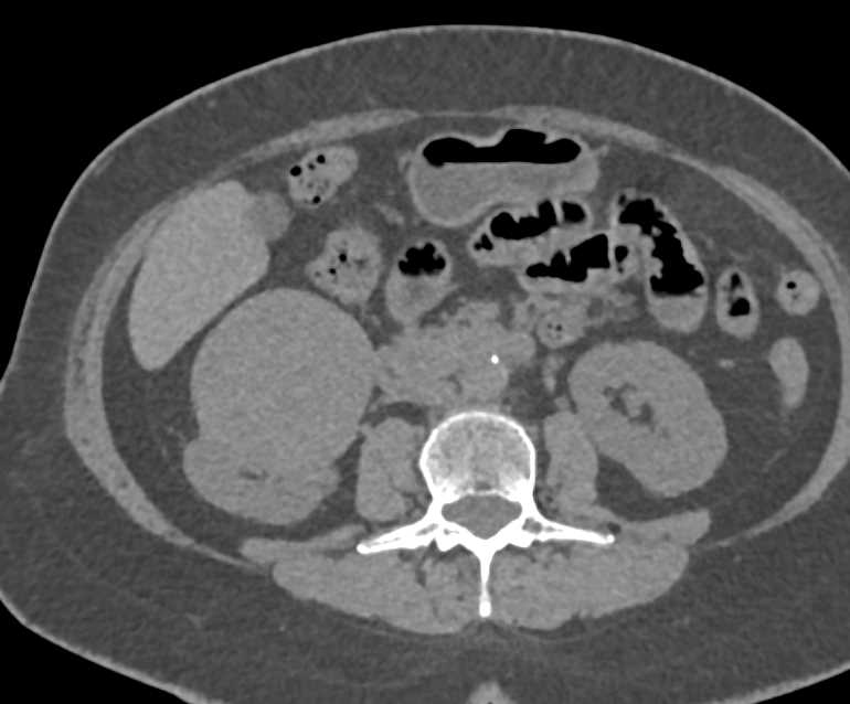 Papillary Right Renal Cell Carcinoma - CTisus CT Scan