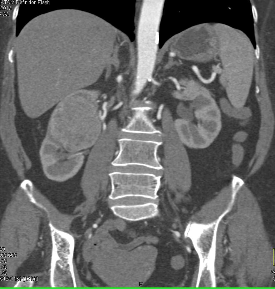 Papillary Right Renal Cell Carcinoma - CTisus CT Scan