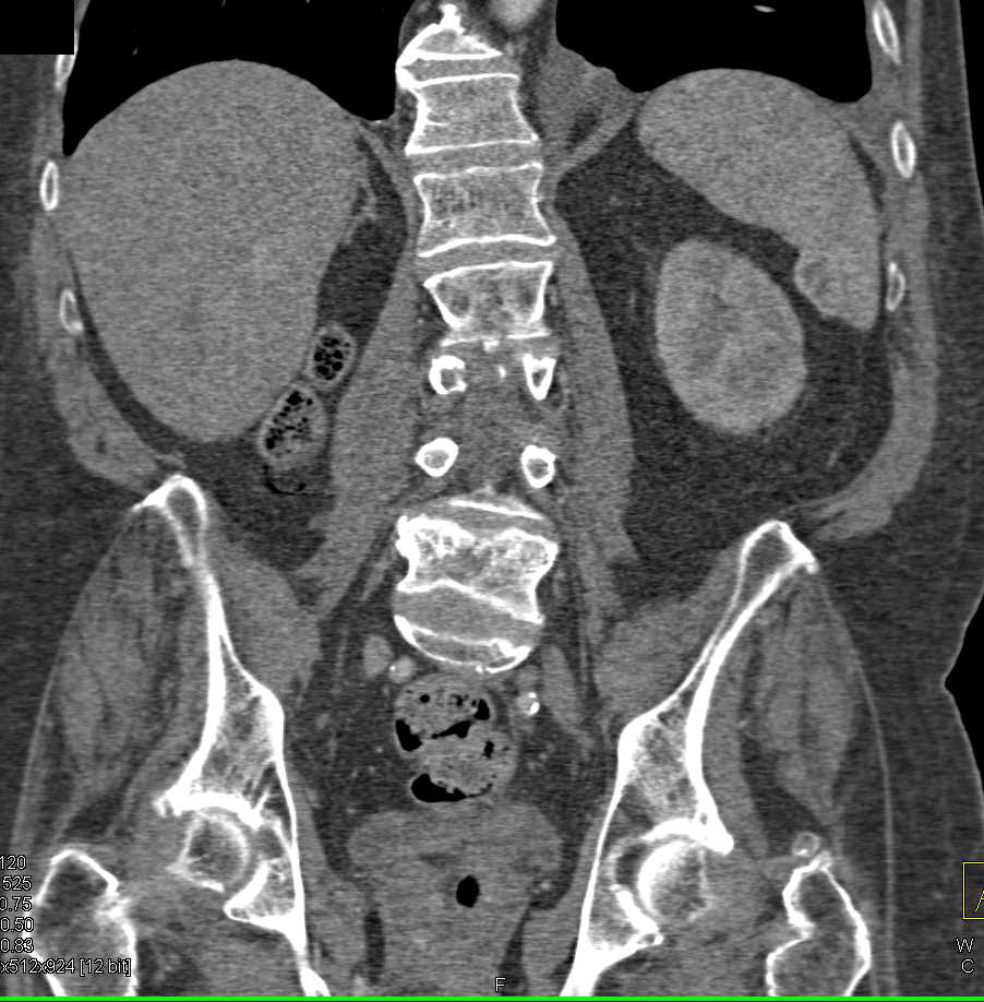 Metastatic Renal Cell Carcinoma to Bone and Stomach - CTisus CT Scan