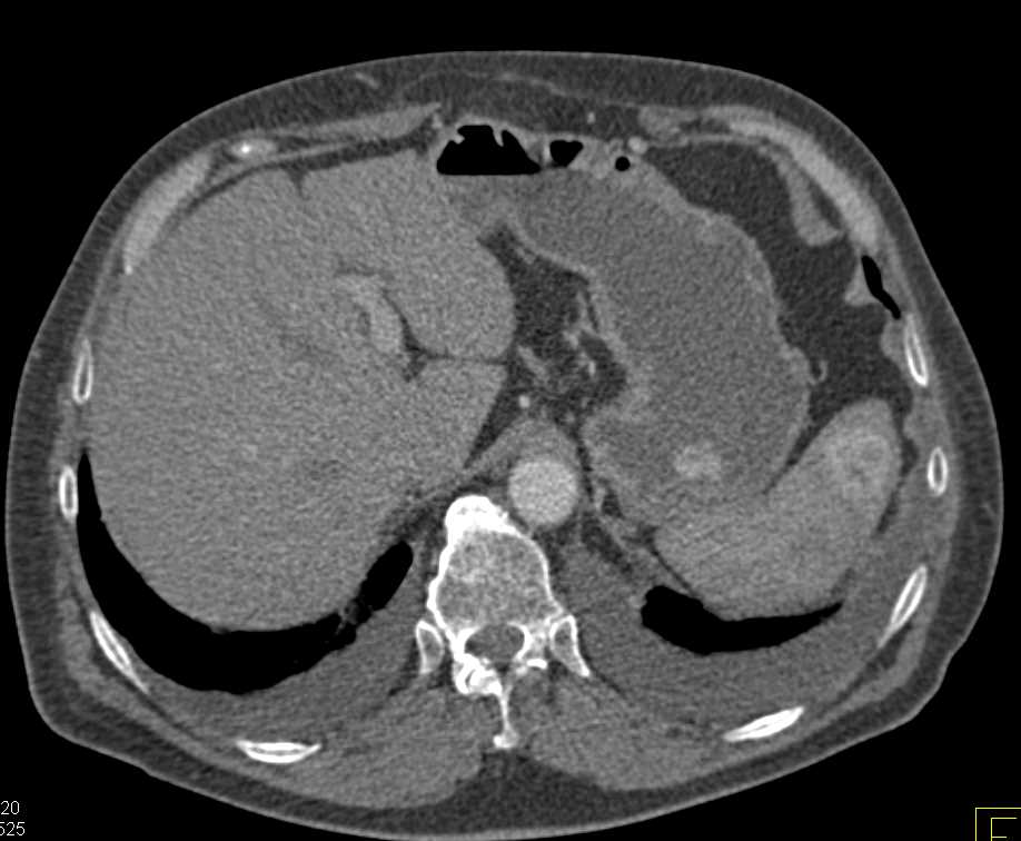 Metastatic Renal Cell Carcinoma to Lung, Pleura, Bone and Stomach - CTisus CT Scan