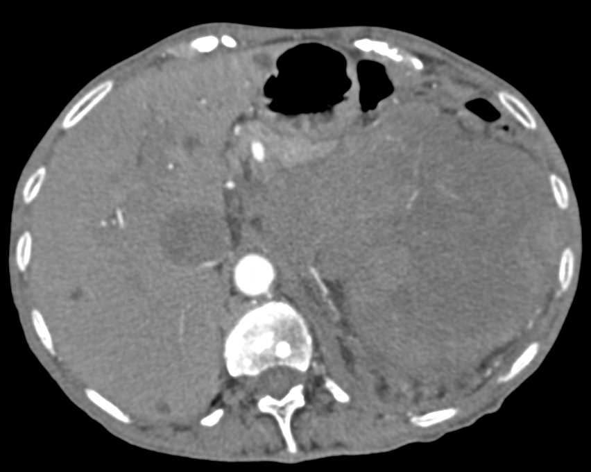 Renal Cell Carcinoma with Bleed and Vascular Invasion - CTisus CT Scan